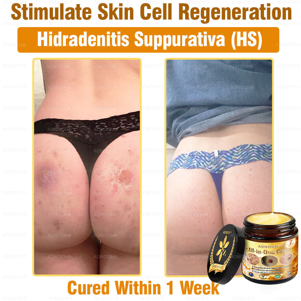Official Store ADNOON® Multi-Effect All-in-One Skincare Cream Certified by The Australasian College of Dermatologists (ACD) (Treating Skin Cancer, Eczema, Acne, Warts, Psoriasis, Wrinkles, Scars, and Varicose Veins)