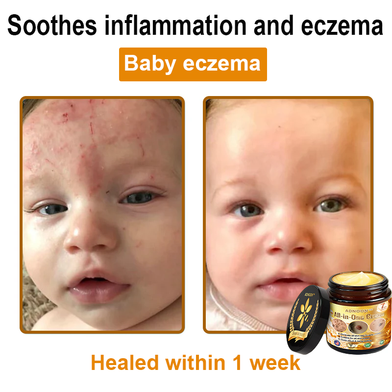Official Store ADNOON® Multi-Effect All-in-One Skincare Cream Certified by The Australasian College of Dermatologists (ACD) (Treating Skin Cancer, Eczema, Acne, Warts, Psoriasis, Wrinkles, Scars, and Varicose Veins)