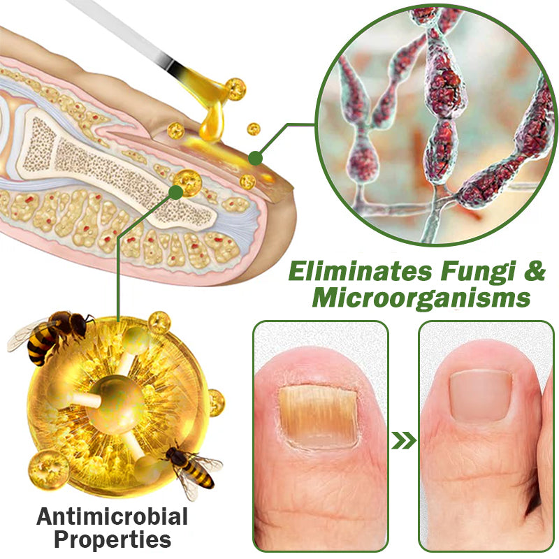👩⚕️☘️Furzero™ Nail Defense Bee Venom Treatment Serum(For All Kinds Of Nail Diseases✅For Healthier Nail Growth)