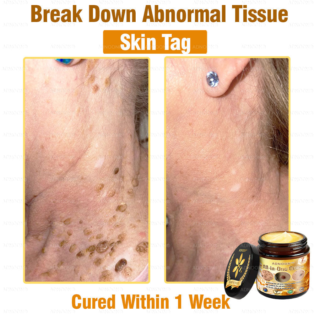 Official Store ADNOON® Multi-Effect All-in-One Skincare Cream Certified by The Australasian College of Dermatologists (ACD) (Treating Skin Cancer, Eczema, Acne, Warts, Psoriasis, Wrinkles, Scars, and Varicose Veins)