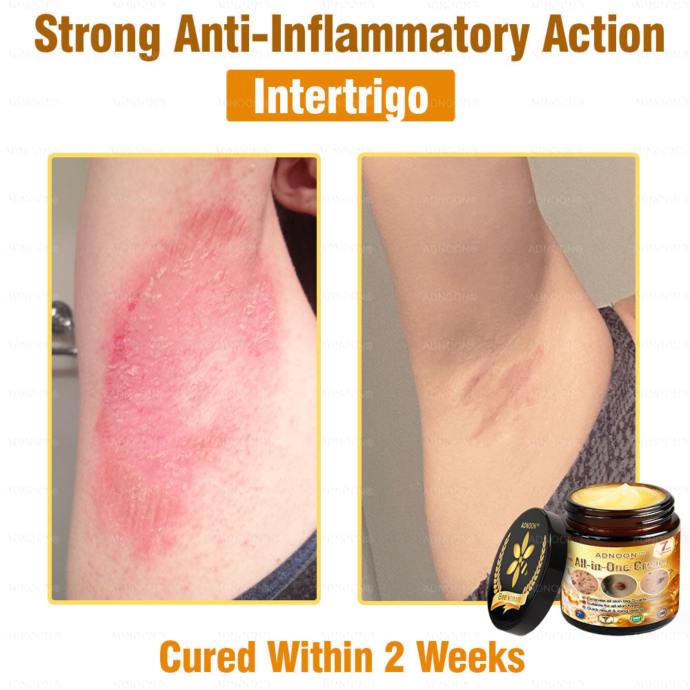 Official Store ADNOON® Multi-Effect All-in-One Skincare Cream Certified by The Australasian College of Dermatologists (ACD) (Treating Skin Cancer, Eczema, Acne, Warts, Psoriasis, Wrinkles, Scars, and Varicose Veins)