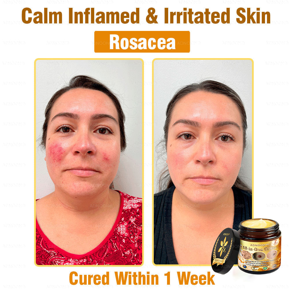 Official Store ADNOON® Multi-Effect All-in-One Skincare Cream Certified by The Australasian College of Dermatologists (ACD) (Treating Skin Cancer, Eczema, Acne, Warts, Psoriasis, Wrinkles, Scars, and Varicose Veins)
