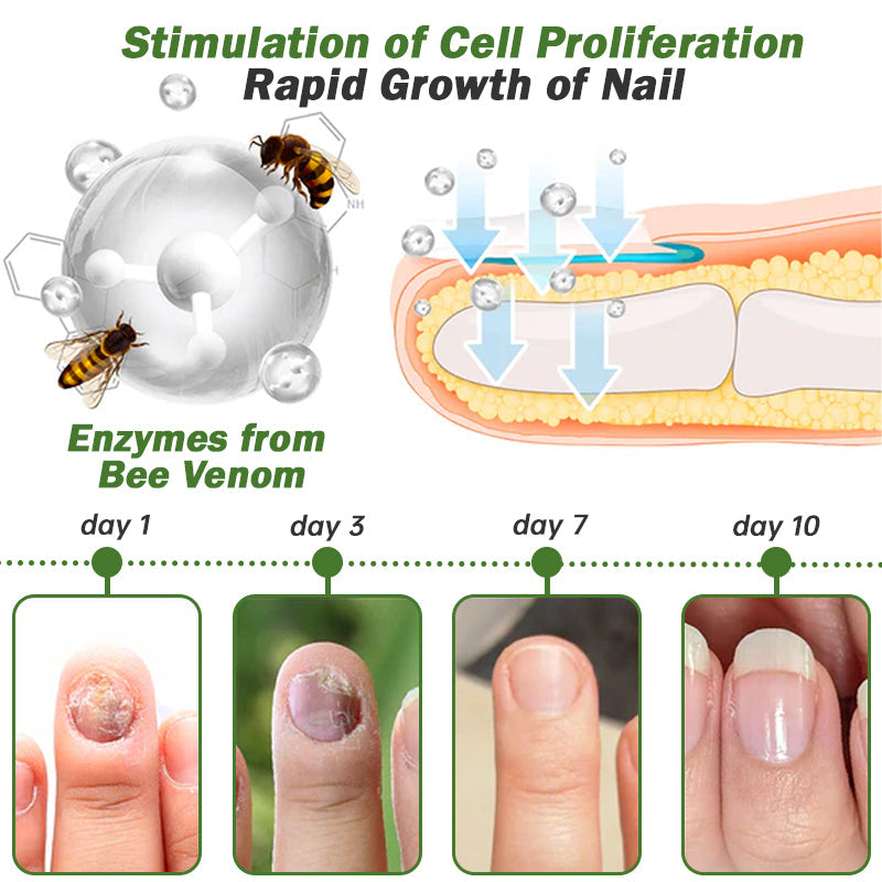 👩‍⚕️⭐Furzero™ Nail Defense Bee Venom Treatment Serum(For All Kinds Of Nail Diseases✅For Healthier Nail Growth)