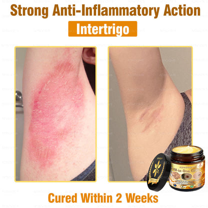 Official Store ADNOON® Multi-Effect All-in-One Skincare Cream Certified by The Australasian College of Dermatologists (ACD) (Treating Skin Cancer, Eczema, Acne, Warts, Psoriasis, Wrinkles, Scars, and Varicose Veins)